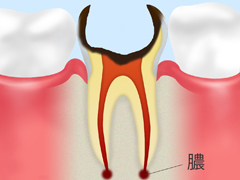 C4　歯の根の虫歯