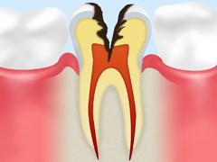 C3　神経の虫歯