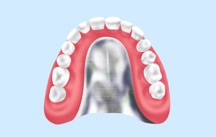 金属床義歯