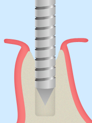 インプラント埋入
